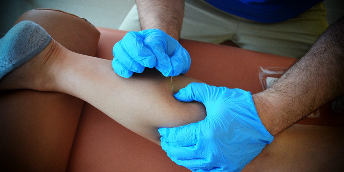 Formation en Dry-Needling